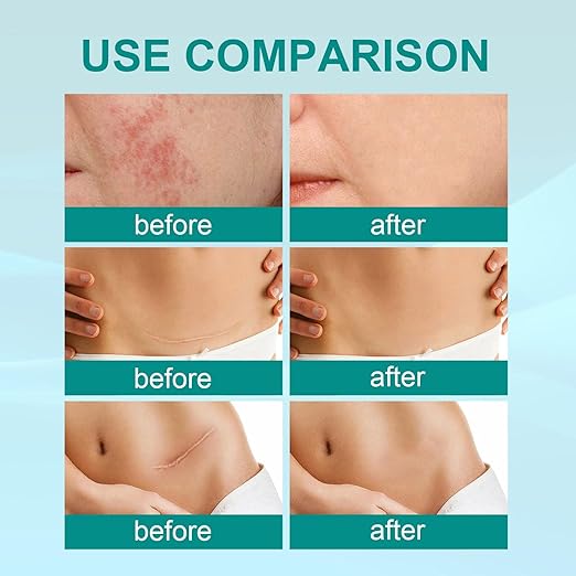 South Moon Medical Grade Scar Spray