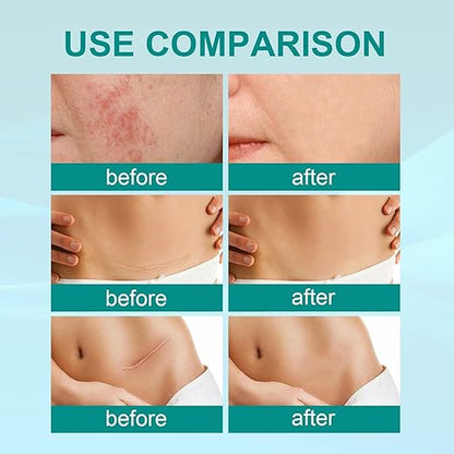 South Moon Medical Grade Scar Spray